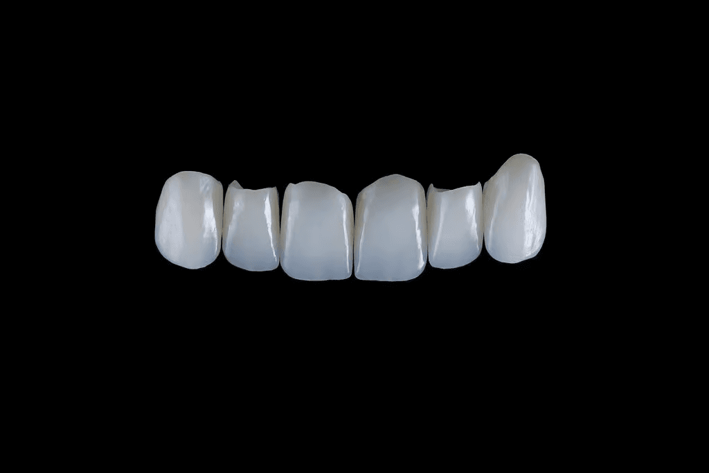 E.max Ceramic Veneer