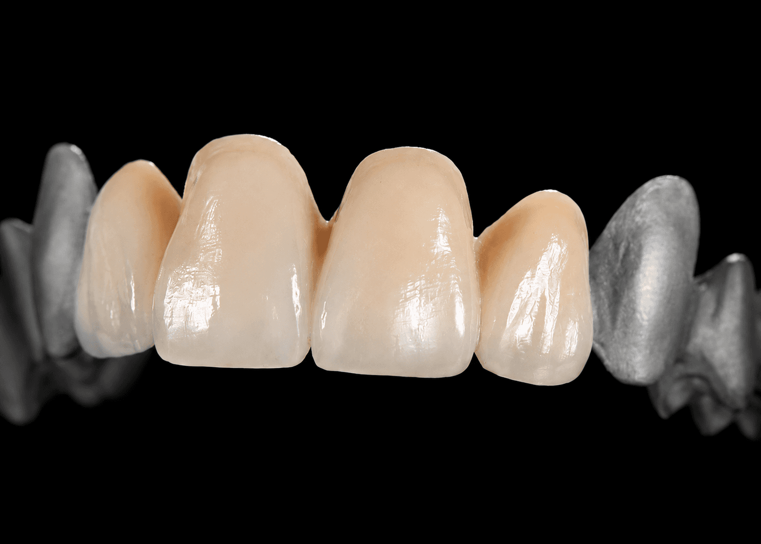 SLM PFM Crown & Bridge