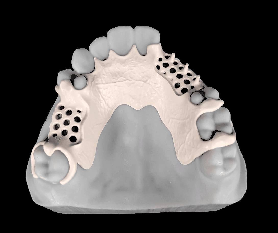 Cobalt Chrome Partial Denture Framework Design: A Practical Guide for Dental Labs and Clinics