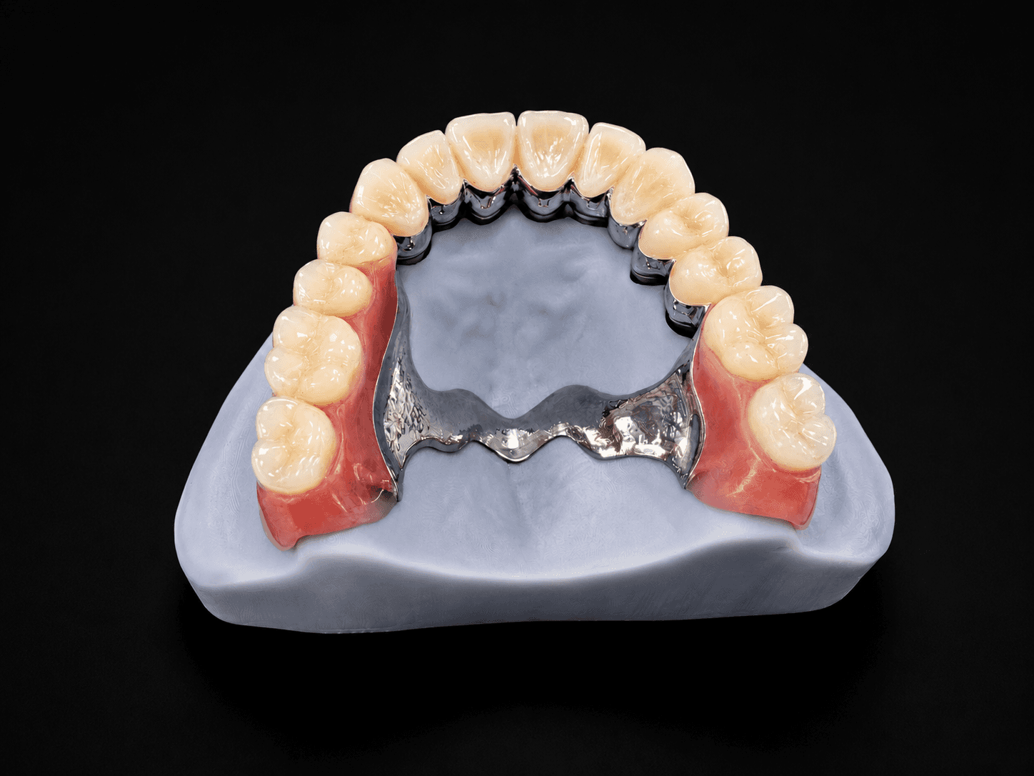 Telescopic Crown Denture