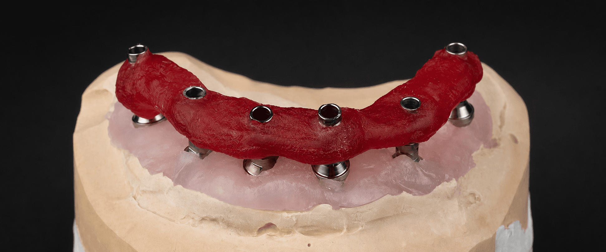 Full-Arch Implant Verification Jig: When Is It Needed and What Should the Lab Receive?