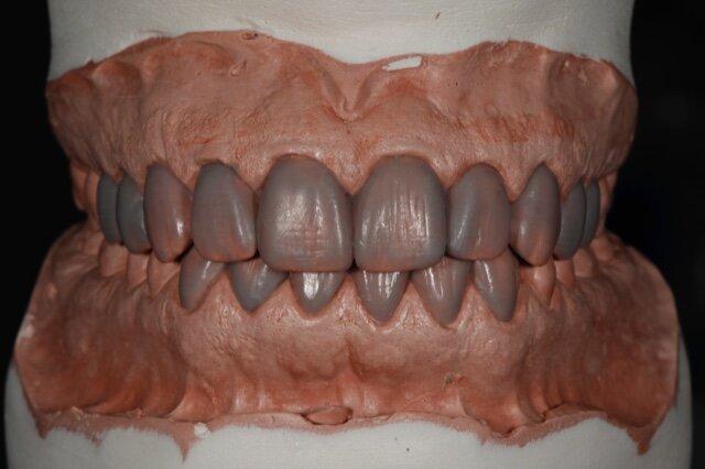 Complete Denture Wax Try-In Checklist: What to Approve Before Final Processing