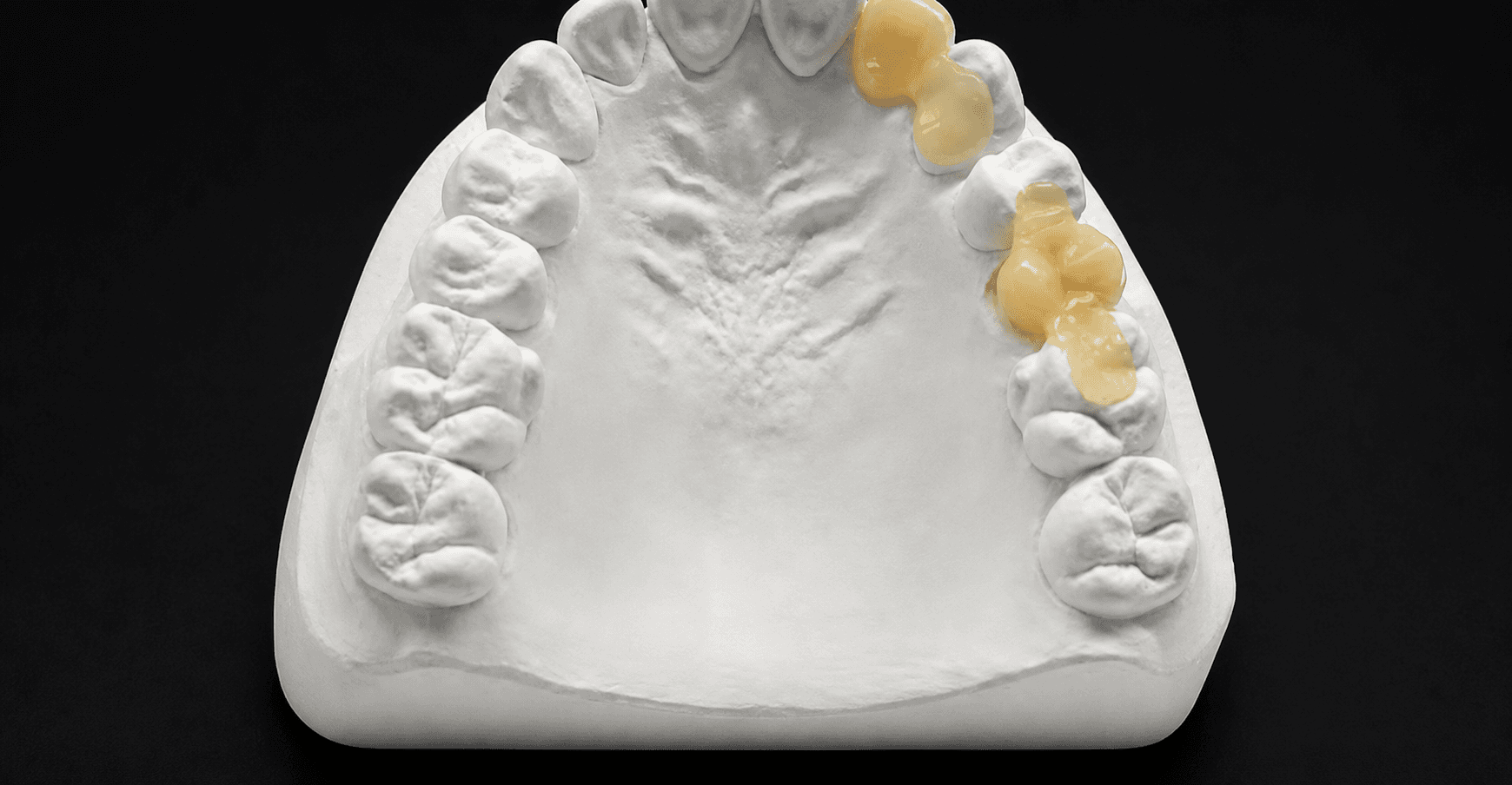Maryland Bridge Case Submission Guide: Design Options and Records Dental Labs Need